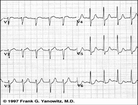 sindrome_coronario_agudo/ECG_4