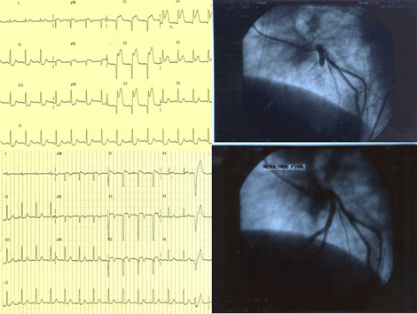 sindrome_coronario_agudo/comprobacion_angiografica_recanalizacion