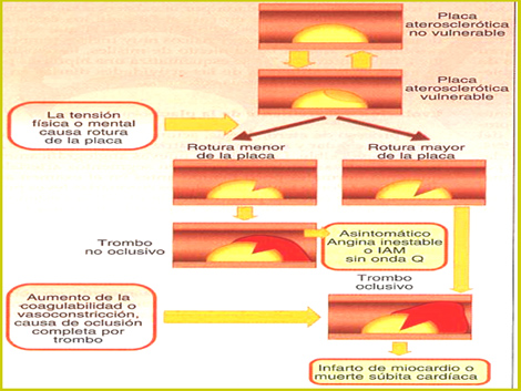 sindrome_coronario_agudo/placa_aterosclerotica