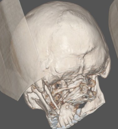 sindrome_eagle_caso/TAC_craneal_reconstruccion_3D