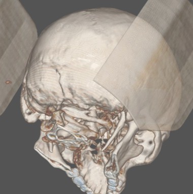 sindrome_eagle_caso/TAC_reconstruccion_3D