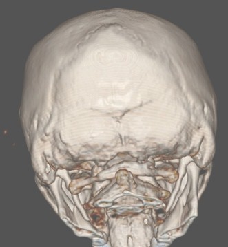 sindrome_eagle_caso/clinico_TAC_tomografia