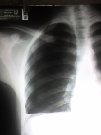 trauma_torax_toracico/Rx_opacidades_1 trauma_torax_toracico/Rx_opacidades_1