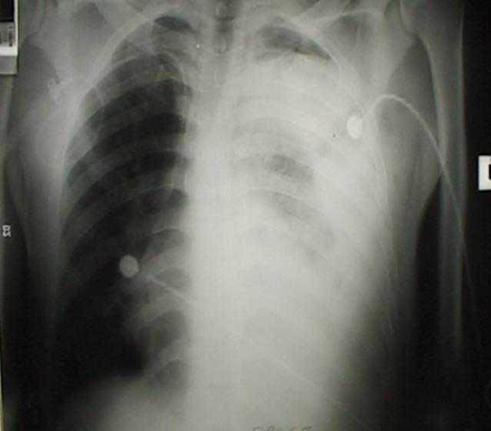 trauma_torax_toracico/Rx_opacidades_2 trauma_torax_toracico/Rx_opacidades_2