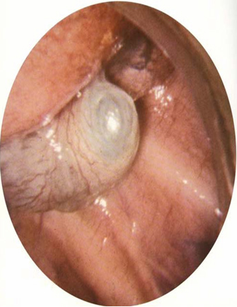 trauma_torax_toracico/bulla_visualizada_toracoscopia trauma_torax_toracico/bulla_visualizada_toracoscopia