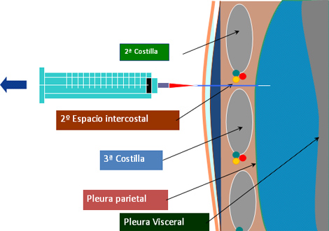 trauma_torax_toracico/descompresion_toracica