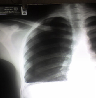 trauma_torax_toracico/hemotorax_masivo_2 trauma_torax_toracico/hemotorax_masivo_2