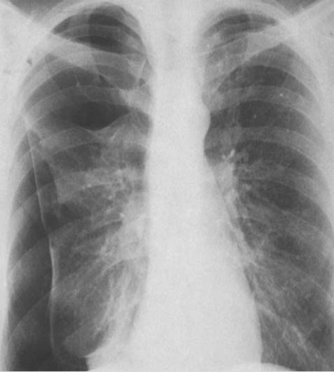 trauma_torax_toracico/neumotorax_espontaneo_primario trauma_torax_toracico/neumotorax_espontaneo_primario