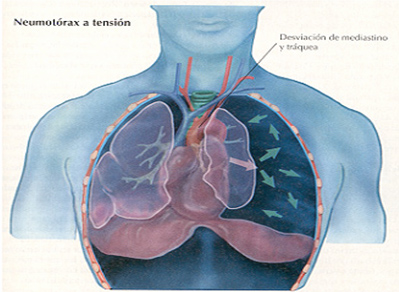 trauma_torax_toracico/neumotorax_tension_1