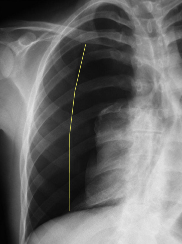 trauma_torax_toracico/neumotorax_total_derecho trauma_torax_toracico/neumotorax_total_derecho