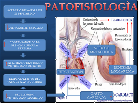 trauma_torax_toracico/patofisiologia_taponamiento_cardiaco