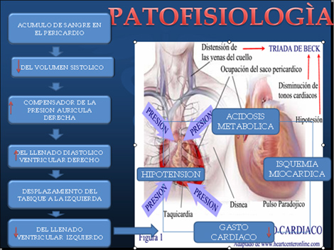 trauma_torax_toracico/patofisiologia_taponamiento_cardiaco trauma_torax_toracico/patofisiologia_taponamiento_cardiaco
