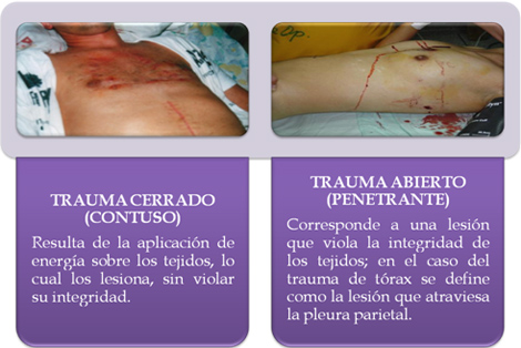 trauma_torax_toracico/trauma_toracico_1 trauma_torax_toracico/trauma_toracico_1