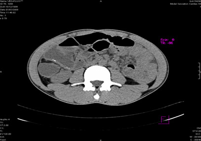 tuberculosis_pulmonar_extrapulmonar/tuberculosis_intestinal_1