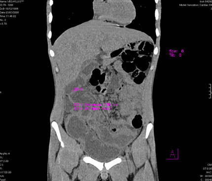 tuberculosis_pulmonar_extrapulmonar/tuberculosis_intestinal_2