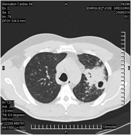 tuberculosis_pulmonar_extrapulmonar/tuberculosis_pulmonar_1