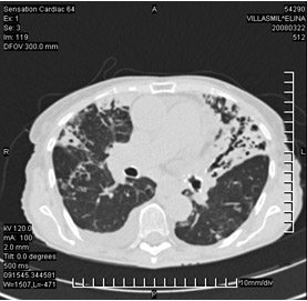 tuberculosis_pulmonar_extrapulmonar/tuberculosis_pulmonar_2