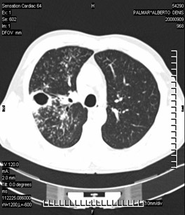 tuberculosis_pulmonar_extrapulmonar/tuberculosis_pulmonar_3 tuberculosis_pulmonar_extrapulmonar/tuberculosis_pulmonar_3