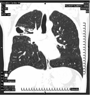 tuberculosis_pulmonar_extrapulmonar/tuberculosis_pulmonar_4
