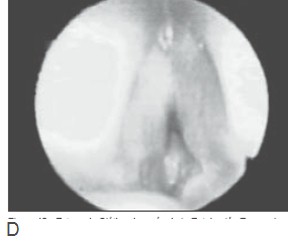 via_aerea_criticos/estenosis_glotica_postintubacion via_aerea_criticos/estenosis_glotica_postintubacion