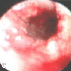 via_aerea_criticos/traqueostoma_granuloma_intubacion via_aerea_criticos/traqueostoma_granuloma_intubacion