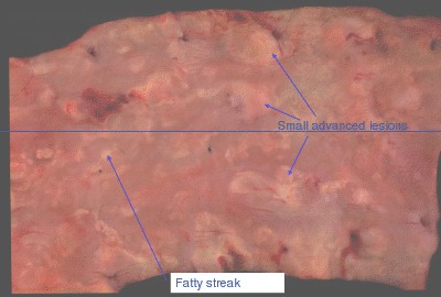 modelo_animal_arteriosclerosis/aorta_humana_aterosclerotica