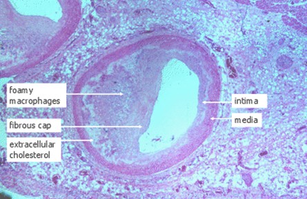 modelo_animal_arteriosclerosis/arteria_coronaria_aterosclerosis