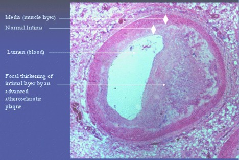 modelo_animal_arteriosclerosis/arteria_coronaria_aterosclerotica