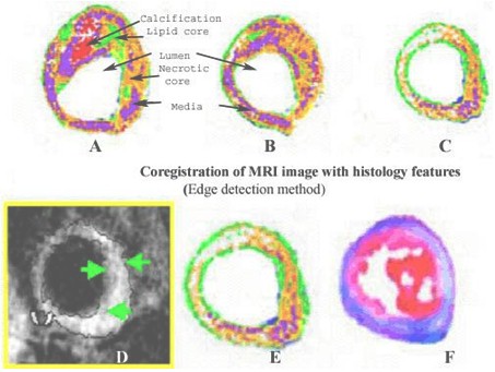 modelo_animal_arteriosclerosis/coronary_atheroma