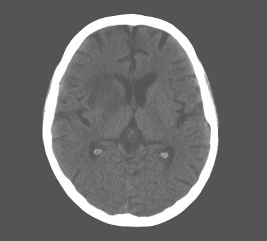 neurotoxoplasmosis_SIDA_HIV/alteraciones_cerebrales_TAC neurotoxoplasmosis_SIDA_HIV/alteraciones_cerebrales_TAC