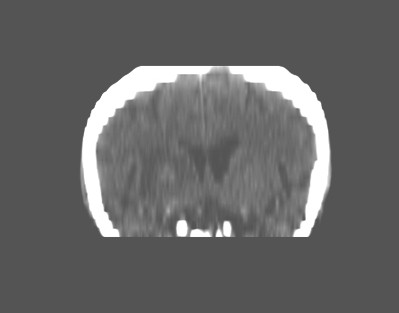 neurotoxoplasmosis_SIDA_HIV/corte_multiplanar_coronal neurotoxoplasmosis_SIDA_HIV/corte_multiplanar_coronal