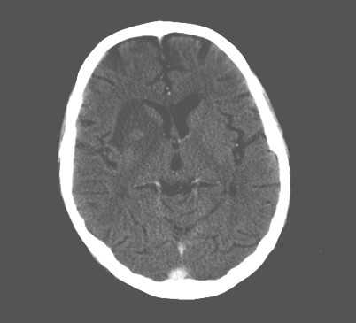 neurotoxoplasmosis_SIDA_HIV/imagen_hipodensa_hiperdensa