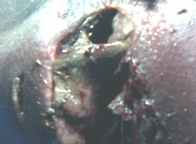 Daikin_gangrena_Fournier/necrosis_perineal_purulenta Daikin_gangrena_Fournier/necrosis_perineal_purulenta