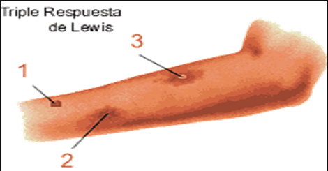 autacoides_respuesta_inflamatoria/triple_respuesta_lewis