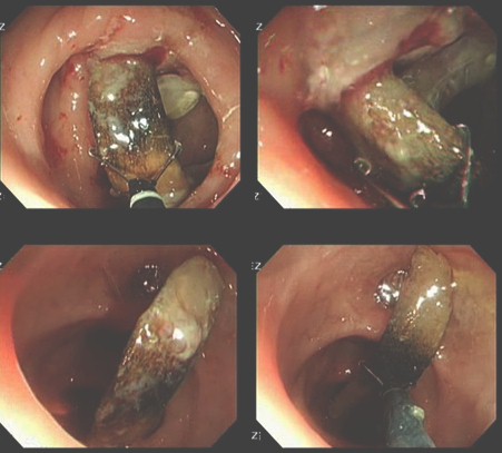 diverticulitis_asintomatica_impactacion/extraccion_endoscopia_pinza