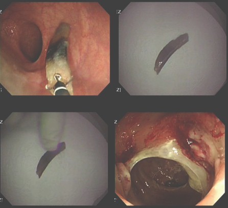 diverticulitis_asintomatica_impactacion/extraccion_endoscopica_diverticulo