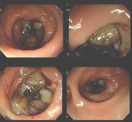 diverticulitis_asintomatica_impactacion/hueso_impactado_diverticulo