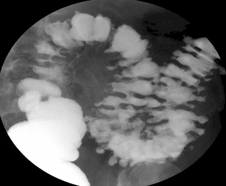 enema_hemorragia_diverticular/opaco_sulfato_bario enema_hemorragia_diverticular/opaco_sulfato_bario