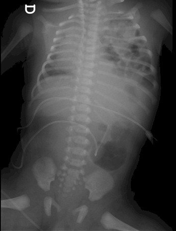 hernia_diafragmatica_congenita/desplazamiento_mediastinico_mediastino