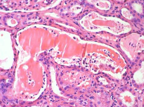 mieloma_renal_caso/histologia_anatomia_patologica