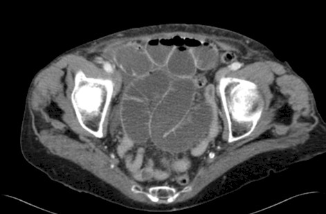 obstruccion_hernia_obturatriz/TAC_abdominal_intestinal obstruccion_hernia_obturatriz/TAC_abdominal_intestinal
