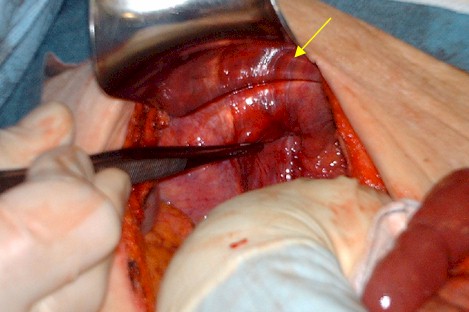 obstruccion_hernia_obturatriz/cirugia_abdomen_agudo obstruccion_hernia_obturatriz/cirugia_abdomen_agudo