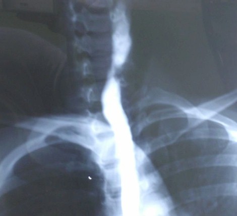 sindrome_Plummer_Vinson/cartilago_cricoides_esofago sindrome_Plummer_Vinson/cartilago_cricoides_esofago