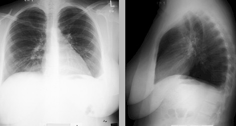 tromboembolismo_pulmonar_TEP/radiografia_rx_torax