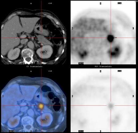 carcinoma_esofago_oat-cell/CT_PET_pancreas carcinoma_esofago_oat-cell/CT_PET_pancreas