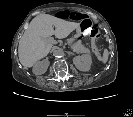 carcinoma_esofago_oat-cell/TAC_cancer_pancreas