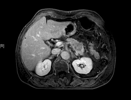 carcinoma_esofago_oat-cell/carcinoma_oat_cell