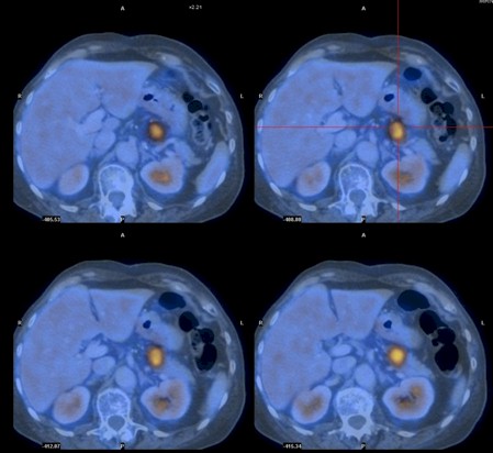 carcinoma_esofago_oat-cell/lesion_neoplasica_pancreas