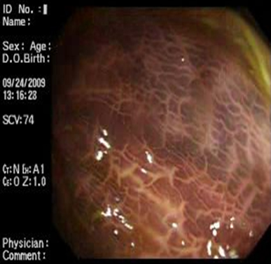 melanosis_coli_laxantes/mucosa_colonica_2