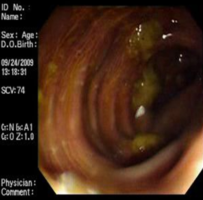 melanosis_coli_laxantes/mucosa_colonica_4